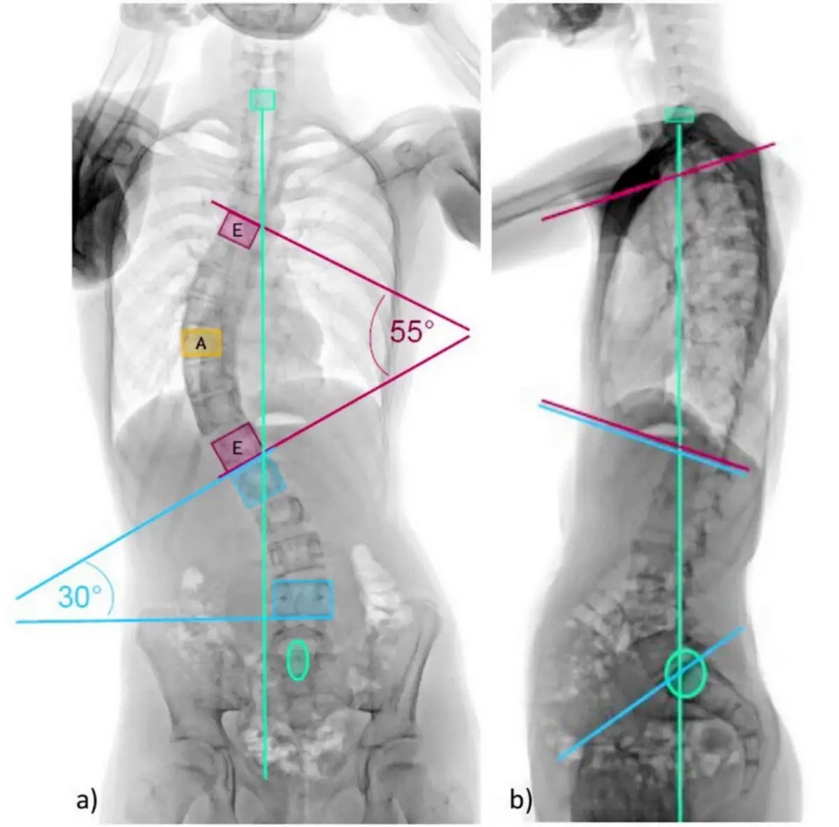 Radiographie de la colonne vertébrale avec une scoliose et avec une cyphose